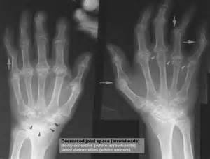 arthritis x-ray